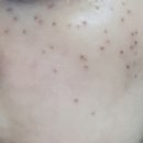 (주)브이알플러스 | 편평사마귀 얼굴+목 레이저 제거 10일차 후기 (사진주의ㅎ) 재생테이프X 재생크림O