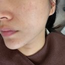 지라인 | 다산 별내피부과 30대 중반 웨딩관리로 선택한 리니어지라인리프팅 후기