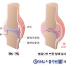 무릎에 물이 차면 꼭 빼야 할까?이상훈의 무릎 이야기 이미지