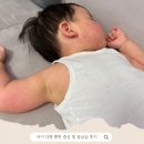 성모반점 | 아기 두드러기 피부 붉은 반점 다형 홍반 증상 및 응급실 후기