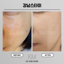 강남스타미 | 강남역 피부관리 전문, 강남탈모 두피&탈모&피부스타미 강남역점 리프팅 탄력 케어 효과 강남스타미 후기