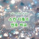 스킨딜라잇 | 구미 스킨 디톡스 관리 후기 - 전후 비교와 고객 공통 리뷰