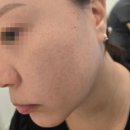 새솔약국 | 피코슈어토닝 1회차 후기 (내돈내산)