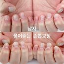 네일스페셜리 | [하남미사] 남자 물어뜯는 손톱교정 네일스페셜리