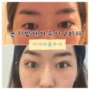 삼성중앙역 눈두덩이지방제거주사 아이마블주사 2회차 효과, 시기, 통증 솔직후기