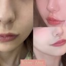 디자인퍼휴먼 | 인중축소수술후기 흉터와 회복과정을 보고 결정하세요