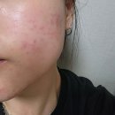 연세에이치의원 | 경기도 수원시 권선구 권선1동 대상포진 전문병원 추천 | 무료접종 | 예방접종