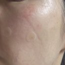 금천의원 | [금천]미앤영의원 얼굴 점 제거 2차 관리중