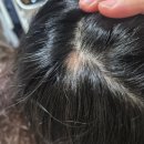 서울대학교병원 | 원형탈모 현재 진행 상태 공유 / 서울대학교병원 피부과 탈모 진료 후기ㅋ