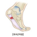 Re:족저근막염이 뭐래유(유)?,,저는 이렇게 했는데 오래지 않아 나았어요 이미지