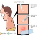 종합병원 아토피 표적치료제 치료비(최초1회한) 특별약관 이미지