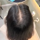 SMP후기 대구두피관리 톡스앤필브로우 대구지점