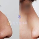 별성형외과 네이버블로그