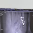 두발로병원 | 20260102 오른발 5중족골 기저부 골절 수술 후 재활 압구정 두발로 정형외과 병원 - 두번째 이야기