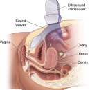 ?난소암과 자궁경부암검사 차이점 이미지