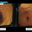 크론병 원인 법 이미지