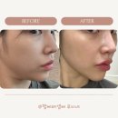 8콘(주) | 강남 피부과 부작용 없는 실루엣소프 후기 콜라겐 리프팅 (효과,통증,붓기,유지기간)