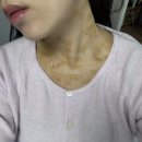 압구정연한의원 | 피부 기록 :: 서울 강남 목 전체 (100개) 편평 사마귀 제거 내돈내산 찐후기