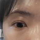 눈밑꺼짐+다크서클 시술후기 압구정에서 인생시술 만났어요