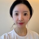 압구정피부과 온다 소프웨이브 리프팅 시술 온웨이브 장단점 다운타임 솔직후기