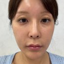 아몬드성형외과의원 | 서울아몬드성형외과논현점 절개 쌍꺼풀수술 눈위 꺼짐 눈두덩이지방이식 가격 붓기 후기 5일차