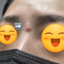 부산영천손한의원 | 부산흉터제거 흉터제거한의원에서 30년된 오래된흉터 치료 9회차 후기 남겨요