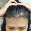 브레인리그/베스터디 | 먹는 탈모약 정리 4탄 :: 아보다트 부작용과 효과