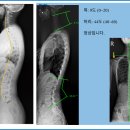 압구정노트정형외과의원 | 사각근 증후군 : 도수치료만으로 호전이 안되었을때 (압구정 노트 정형외과)