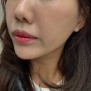 범어역 | 대구범어역피부과 쥬베룩스킨 스킨부스터 후기