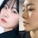 최한의원 | 강남역 리프팅 전문 코프팅 과 V프팅 전후 실제후기