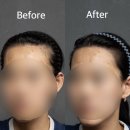 촘촘하게 준비된 내 인생 설계하기 | [헤어라인교정] 결혼 전 헤어라인 정리 받고 인생샷 가능해짐✨강남 언주역 WE BRO (위브로) 후기...