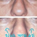 아이뷰성형외과 네이버블로그