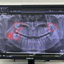 서울치과병원 | [사랑니 발치] 서울대학교 치과병원 치대 당일 외래 진료 후기 신경에 붙어있는 사랑니
