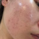 맑은수병원 | 비염치료기 내돈내산 후기 맑은 콧물 줄줄 계절성비염인간