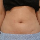 링크성형외과의원 | [배꼽성형후기] 못생긴 배꼽이 콤플렉스였던 나, 링크성형외과에서 인생 배꼽 찾았어요!