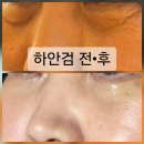 멍스타일 | 인천하안검 송도성형외과 50대 수술 후기 및 부작용 (feat. 하안검 붓기, 멍관리 꿀팁)