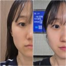 일주일 | 노원 피부과 얼굴 온다리프팅&사각턱보톡스 일주일 후기/가격: 쳐진 볼살 이중턱 순삭