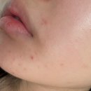 클린업피부과의원 | 나의 피부 암흑기(성인 여드름 피부과 / 아직 치료중)