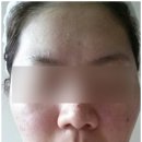 해사람 | 여드름 pdt 레이저 후기 해본 사람은 비추함