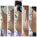 향남 365왁싱&amp;뷰티 테라노바 복부관리 + 관리 후 5일차 후기