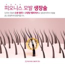 생장수 | 탈모의 해결책! 피오니스 두피생장술을 아시나요? 모발생장술 선택 전, 반드시 봐야할 글!!
