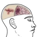 가벼운 뇌진탕 초기증상과 치료 후유증까지 이미지