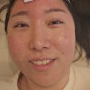 소생한의원 | [부산 여드름관리 / 디데이 프로젝트] 문제성 피부개선 치트키! 화명동 &#34;바이디온&#34; 3회차