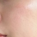 톤즈의원 | 기미제거 대만족한 내돈내산 후기, 건대 톤즈의원