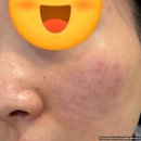 메디컬 오 한의원 모공 주사 모공 리액터 4회차 내돈내산 솔직후기. 마취없이 시술진행 도전!