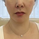 하얀피부과의원 | 강남역 피부과 코레지 에그, 콰트로 포트라 리프팅 레티젠 후기