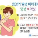 잦은 입 안 염증, 부은 얼굴 타액선 종양? 이미지