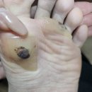 대신냉동 | 4년 묵은 발바닥 사마귀 제거 후기｜냉동치료 대신 주사치료 선택한 이유