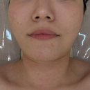경산 중산비소-102 | 경산 펜타힐즈 피부관리 전문 <노어에스테틱> 물방울 관리 후기
