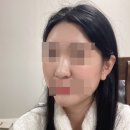 콧대+코끝후기 옆선이 달라짐~ 청담유성형외과
